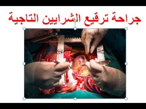 عملية القلب المفتوح ومضاعفاتها - عملية جراحية كبيرة واثارها الجانبية 1209 3