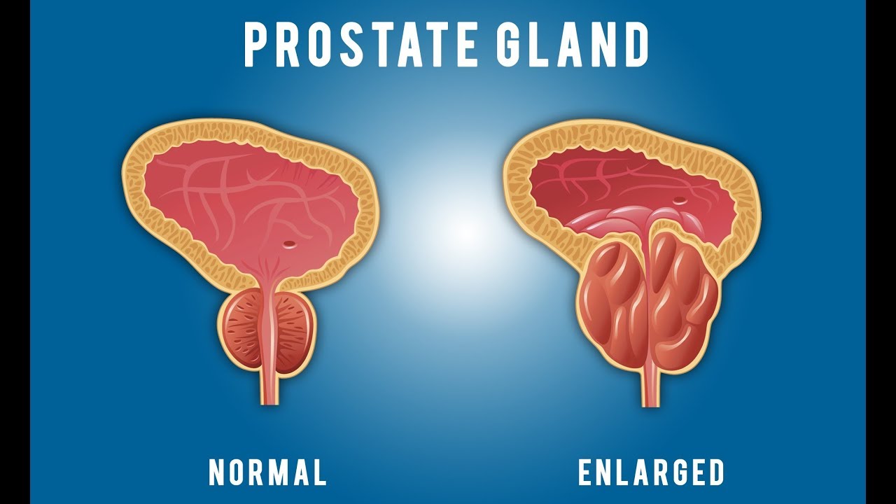 ما هي اعراض تضخم البروستاتا - من اكثر الامراض المنتشره 2354 2