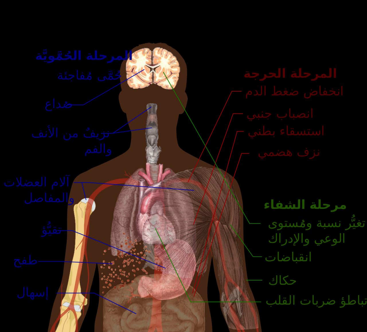 اعراض حمى الضنك - الاسباب التي تؤدي بالاصابة لحمي الضنك 2322