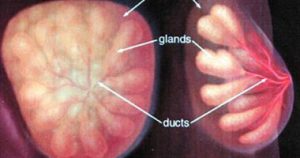 علاج تليف الثدي , سرطان الثدى , 