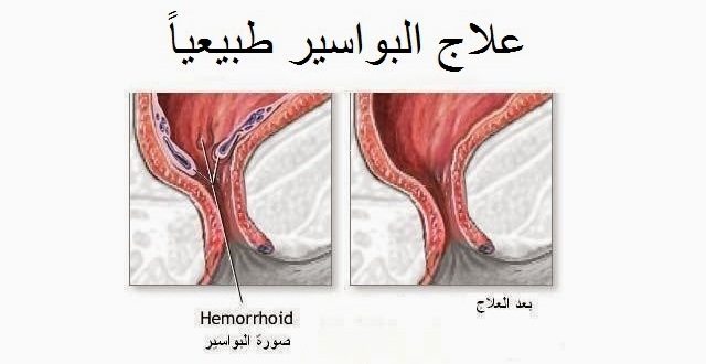 دواء طبيعي للبواسير , طرق علاج رائعه للقضاء علي البواسير