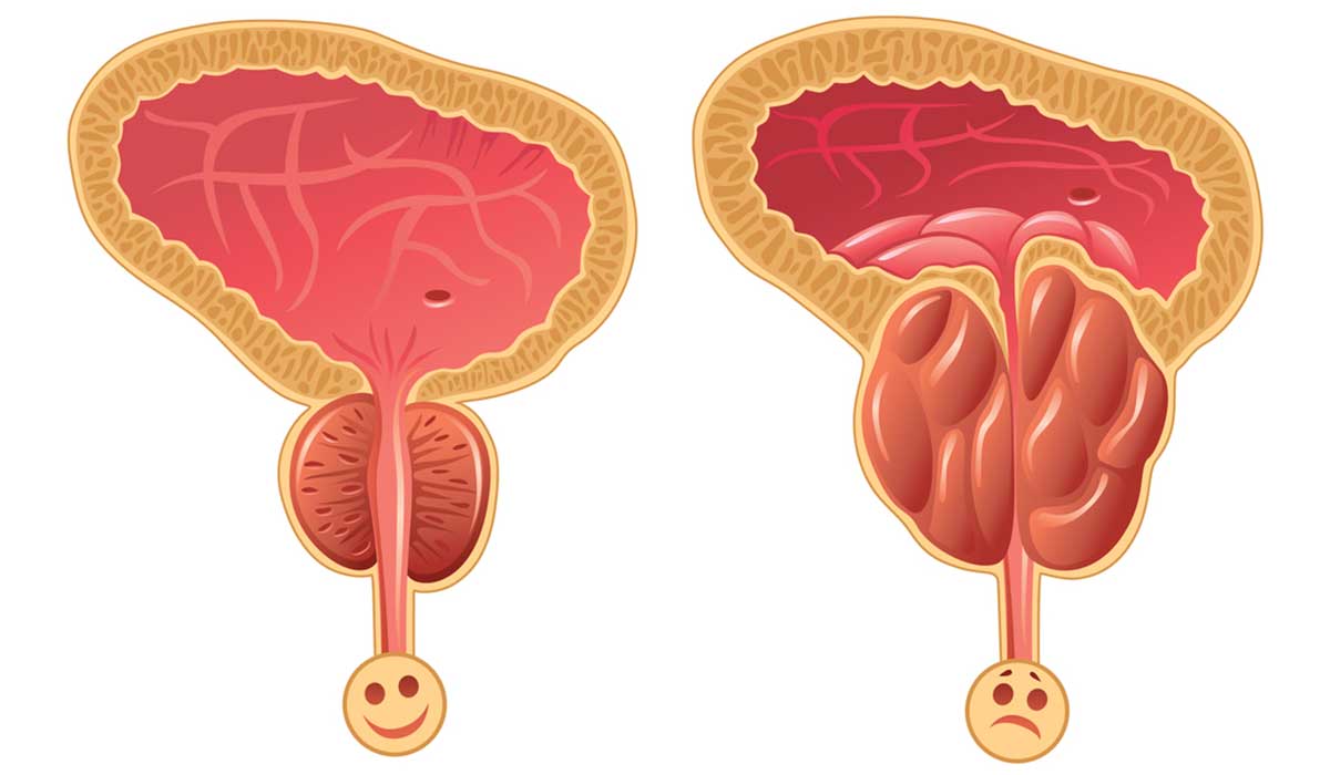 ما هي اعراض تضخم البروستاتا - من اكثر الامراض المنتشره 2354 3