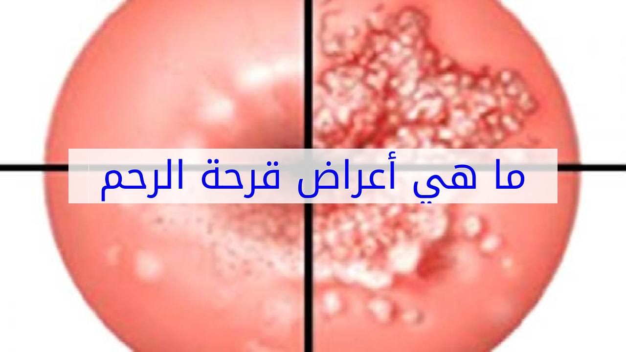 علامات قرحة الرحم - اسباب و علاج قرحة الرحم 3399 1