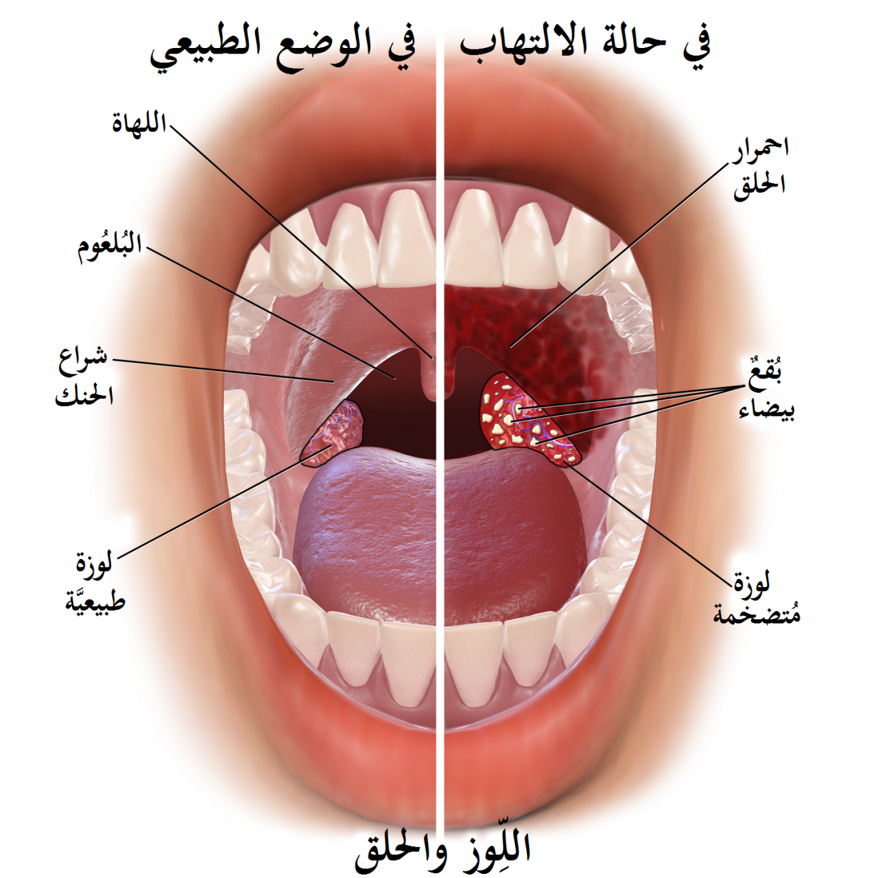 اعراض اللوز الملتهبه - تعرف علي ماذا يحدث لك اذا كنت مصاب باللوز 4476