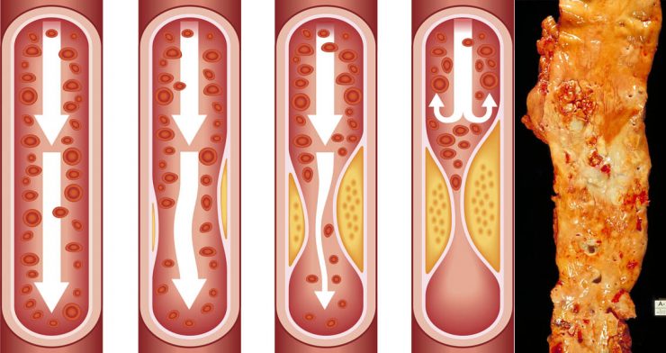 علاج انسداد الشرايين - انسداد وتصلب الشرايين في الجسم 2379 1