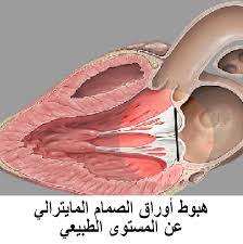 علاج ارتخاء صمام القلب - القلب صمام الحياه علينا الاهتمام 2094 1