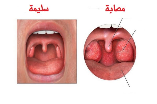 اعراض اللوز الملتهبه - تعرف علي ماذا يحدث لك اذا كنت مصاب باللوز 4476 1