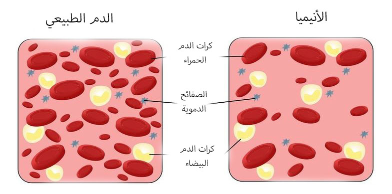 ما هو تحليل Ferritin - علاج نقص مستوي الحديد في الجسم 2404 7