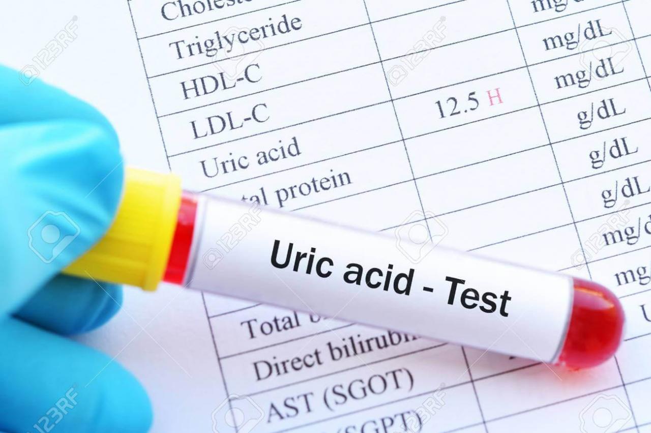 ماهو Uric Acid - تفاصيل عن حمض البوريك