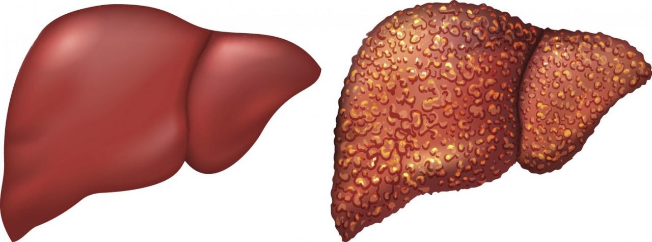 درجات تليف الكبد وعلاجه معلومات مفيدة لمرضى الكبد قبلات الحياة